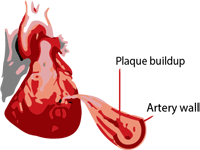 Acute Myocardial Infarction