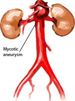 Aortitis