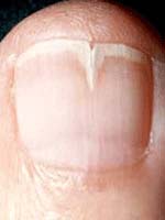 Brittle nails onychorrhexis