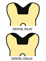 Dental Inlays dental onlays