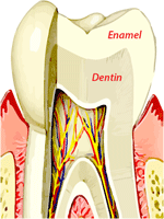 Dental erosion treatment or tooth erosion