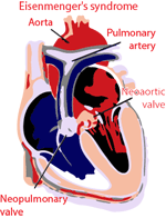 Eisenmengers syndrome