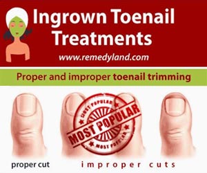 ingrown toenail