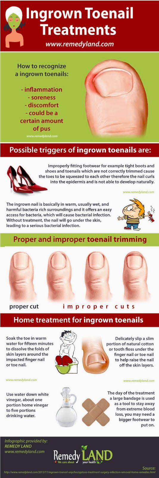 Ingrown toenails onychocryptosis