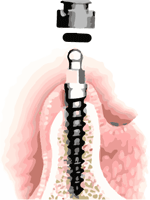 Mini dental implants