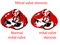 Mitra valve stenosis