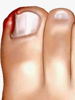 Onychocryptosis ingrown toenail