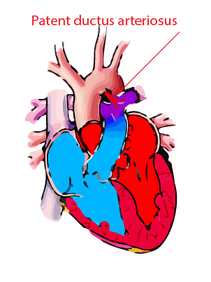 patent ductus arteriosus