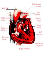 pulmonary valve stenosis