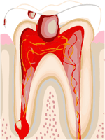 Pulpitis or toothache