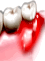 Tooth Abscess Dental Abscess Gum Abscess periodontal Abscess