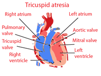 tricuspid atresia