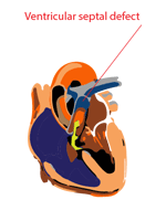 ventricular septal defect