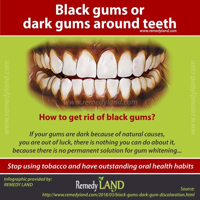 Black Stains On Teeth Near Gums Teethwalls