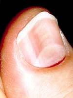 koilonychia spoon shaped nails