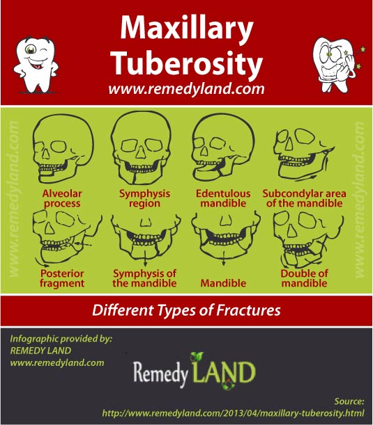 maxillary tuberosity fracture