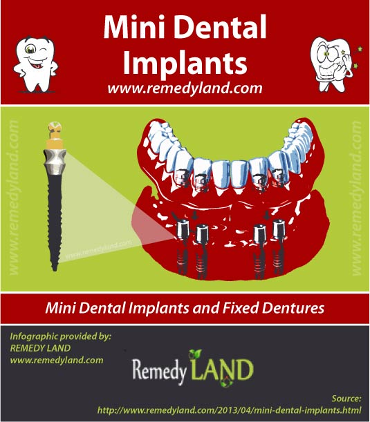 mini dental implants