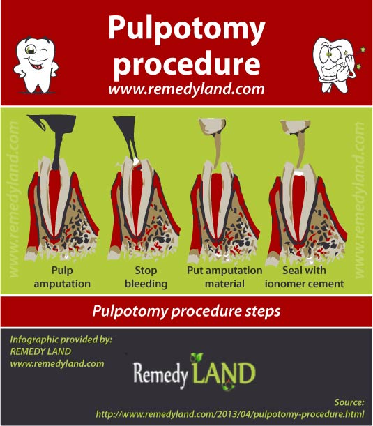 pulpotomy procedure steps