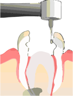 pulpotomy procedure