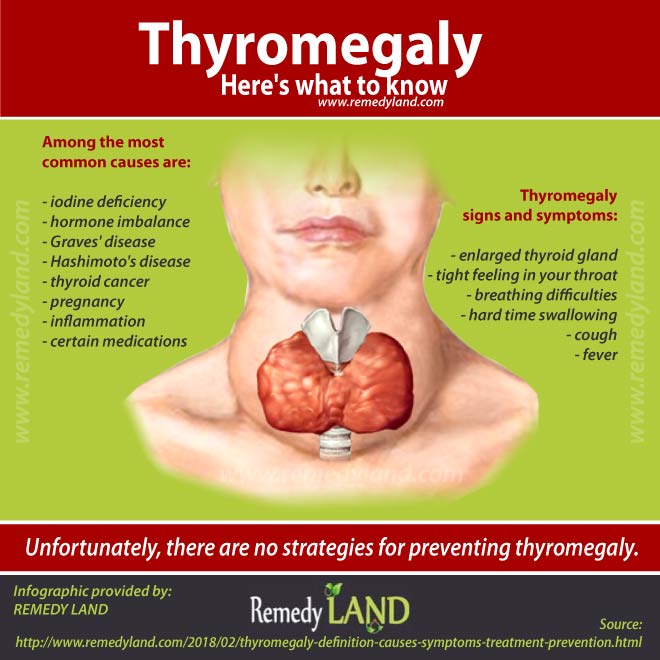 thyromegaly