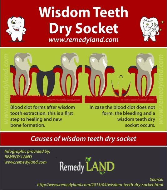 wisdom teeth dry socket